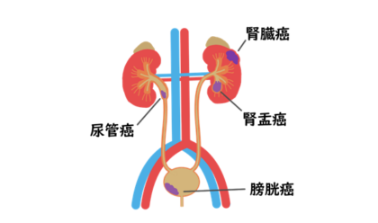 膀胱がん