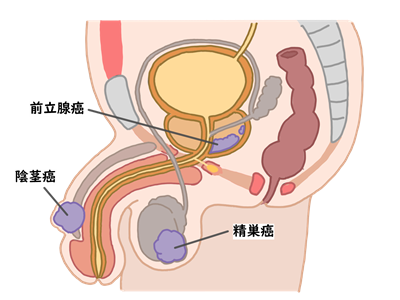 精巣がん