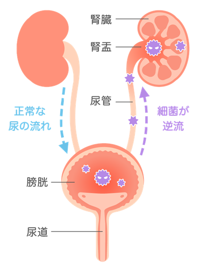 腎盂腎炎とは