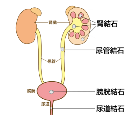尿管結石・腎結石とは？違いとは？