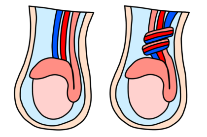 精巣捻転とは